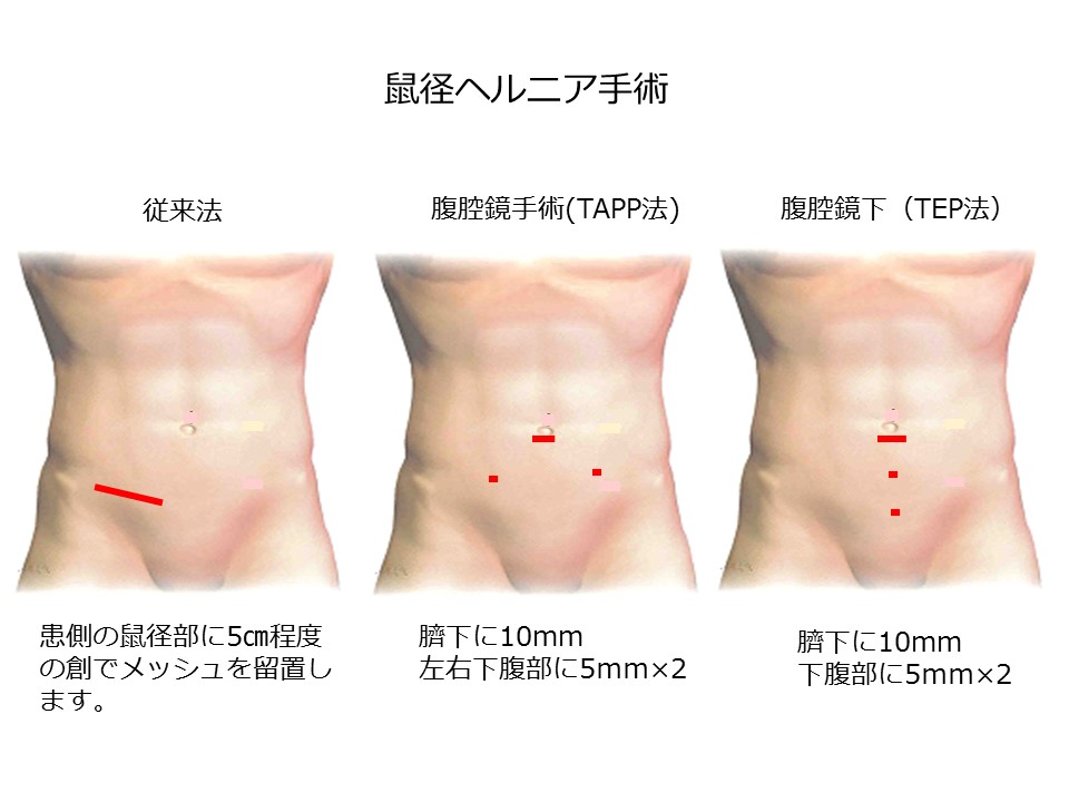 診療について｜一般外科｜診療科｜日本赤十字社 福岡赤十字病院